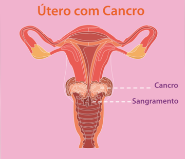 utero-com-cancro